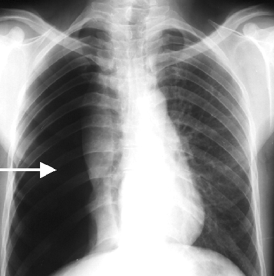 pneumothorax 1 - The Medical student Review