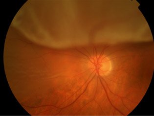 retinal20detachmentJPG 1 - The Medical student Review