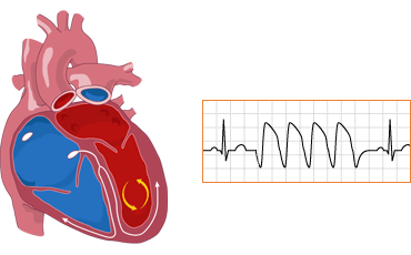 ventricular tach 1 - The Medical student Review