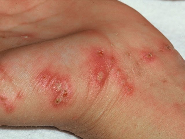 scabies1 1 - The Medical student Review